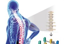 Implan Tulang Belakang Berbahan Titanium