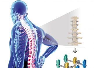 Implan Tulang Belakang Berbahan Titanium